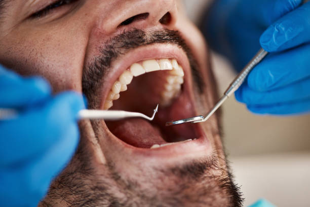 Best Emergency Wisdom Tooth Extraction in Licking, MO